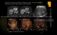 Ultrasonido - enfermedad hepática difusa, fibrosis, cirrosis, puntuación US, CE-LRAD, fibroscan, hepatitis, CEP, HAI, CBP