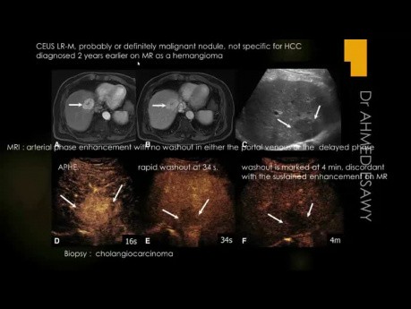 Ultrasonido - enfermedad hepática difusa, fibrosis, cirrosis, puntuación US, CE-LRAD, fibroscan, hepatitis, CEP, HAI, CBP