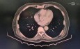 Gastrectomia radical total d2 laparoscopica + colelap