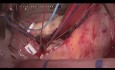 Enfermedad carcinoide tricuspídea - cirugía endoscópica