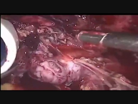 Lesión del uréter - un mioma cervical grande