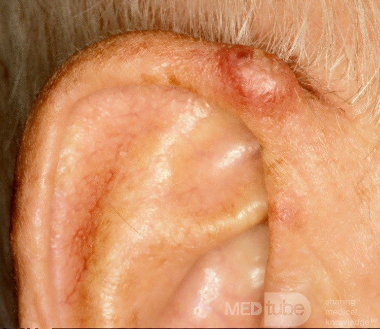 carcinoma de células escamosas