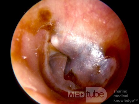 Granuloma de colesterol grande en el oído medio