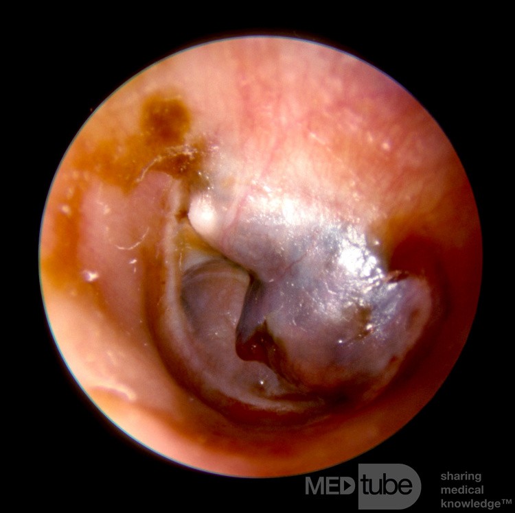 Granuloma de colesterol grande en el oído medio