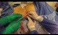 Bypass ureteral subcutáneo para la estenosis ureteral compleja