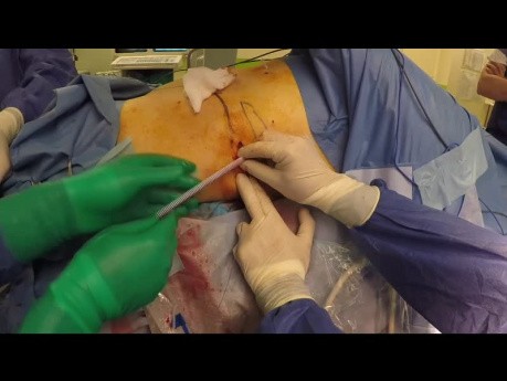 Bypass ureteral subcutáneo para la estenosis ureteral compleja