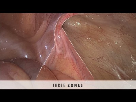 ¿Cómo evitar perderse en la reparación de hernia CMI? Y invertida, tres zonas y cinco triángulos