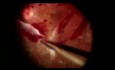 Viscodisección para la retinopatía diabética proliferativa (RDP) fibrótica traccional