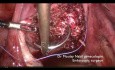 Miomectomía con control de las arterias ilíacas internas