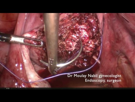 Miomectomía con control de las arterias ilíacas internas