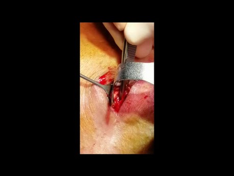 Fractura del piso orbital por estallido; Abordaje retroseptal transconjuntival