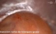 Reparación de hernia de trócar con técnica PeTEP con abordaje craneal