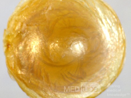 Molde extruido de la membrana timpánica después de una otitis media aguda grave, vista medial