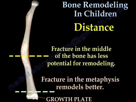 Curación y remodelación ósea en niños - video-clase