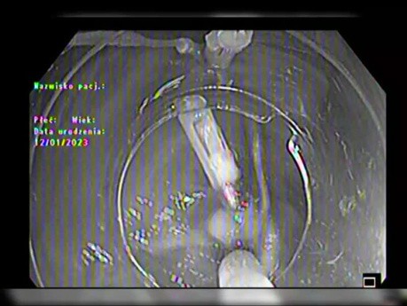 Disección submucosa endoscópica con clip y línea
