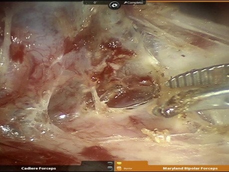 Tumor carcinoide en el bronquio intermedio