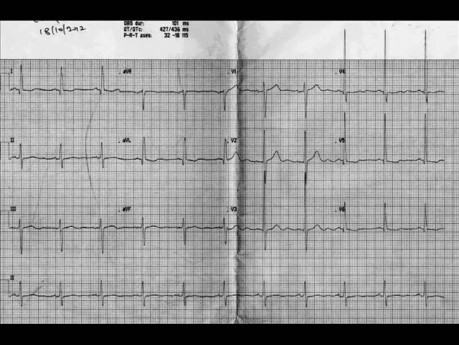 Test de cardiología numero 1 - Caso de ecocardiografía. Un paciente con un soplo cardíaco ECG, ecografía y tratamiento