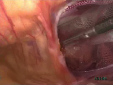 Tratamiento laparoscópico de la hernia inguinal