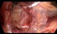 Proctocolectomía total laparoscópica con ileostomía terminal