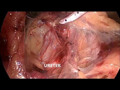 Proctocolectomía total laparoscópica con ileostomía terminal