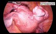 Miomectomía Laparoscópica de la Fibroma de Ligamento Ancho del Útero
