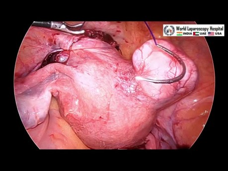 Miomectomía Laparoscópica de la Fibroma de Ligamento Ancho del Útero