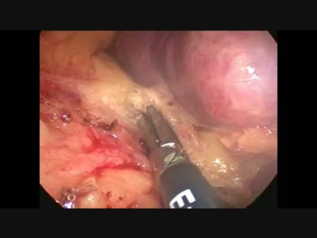 Esplenectomía laparoscópica por abscesos multifocales