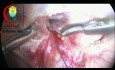 Ganglios linfáticos en la vena testicular