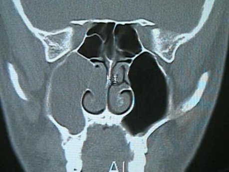 Pólipo coanal - extirpación endoscópica