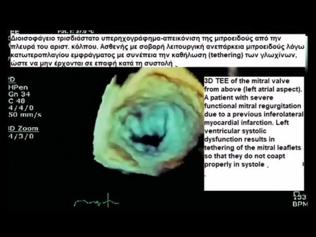 Regurgitación mitral funcional: ecocardiografía transesofágica 2d y 3d 