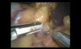 Esplenectomía laparoscópica para los aneurismas múltiples de la arteria esplénica