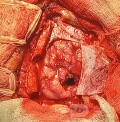 Planificación quirúrgica con neuronavegador en paciente con lesión de masa intracraneal. Glioma de alto grado.