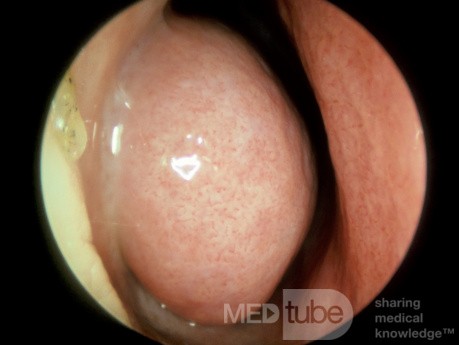 Cornete inferior hinchado [vasodilatado] [izquierdo]