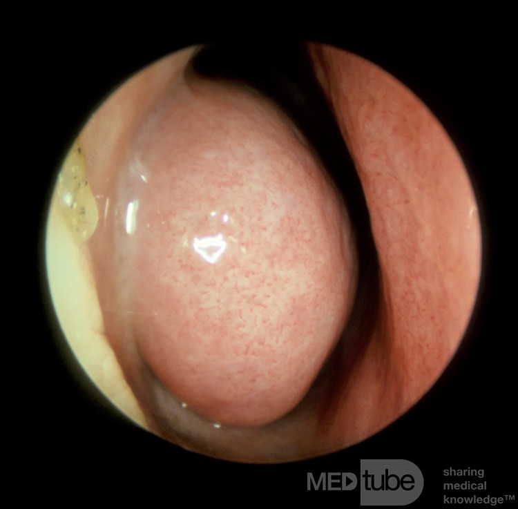 Cornete inferior hinchado [vasodilatado] [izquierdo]
