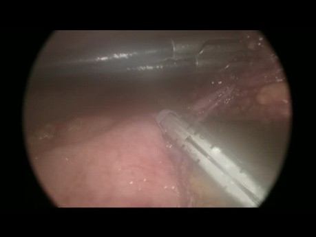 Perforación del intestino delgado en traumatismo abdominal: abordaje laparoscópico