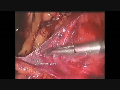 Reparación Total de Hernia Extraperitoneal