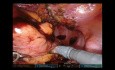 Resección robótica de sigmoides T4 con resección de vejiga e intestino delgado en bloque