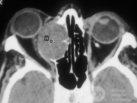 Mucocele frontoetmoidal grande con expansión a la órbita [exploración axial por TC]