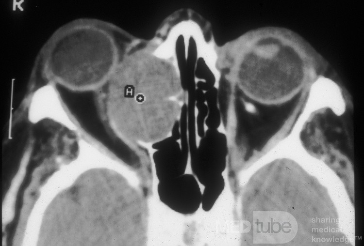 Mucocele frontoetmoidal grande con expansión a la órbita [exploración axial por TC]