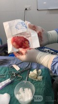Craniectomía descompresiva en infarto maligno de la arteria cerebral media
