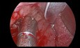 Hemostasia del sangrado postamigdalectomía