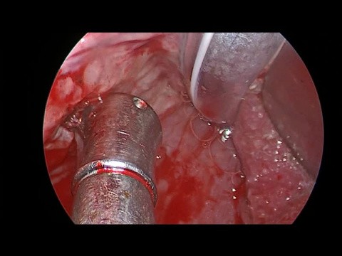 Hemostasia do sangramento pós amigdalectomia