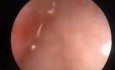 Sangrado vaginal causado por un pólipo endometrial