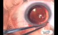 Cirugía TCF de glaucoma con uso de cuchillo de Fugo