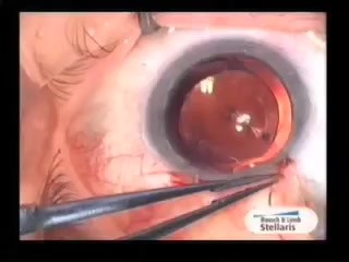 Cirugía TCF de glaucoma con uso de cuchillo de Fugo