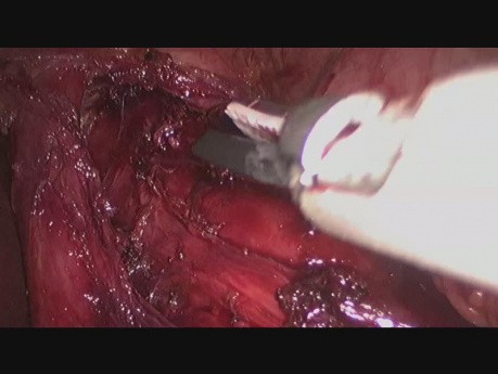 Tratamiento laparoscópico de la acalasia: cardiomiotomía de Heller con fundoplicatura de Dor