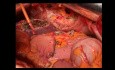 Transversectomía en bloque con resección gástrica segmentaria, hepatectomía atípica 2-3 y resección parcial del diafragma y pericardio para un adenocarcinoma de colon transverso localmente avanzado