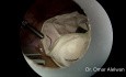 Salpingectomía laparoscópica por embarazo ectópico