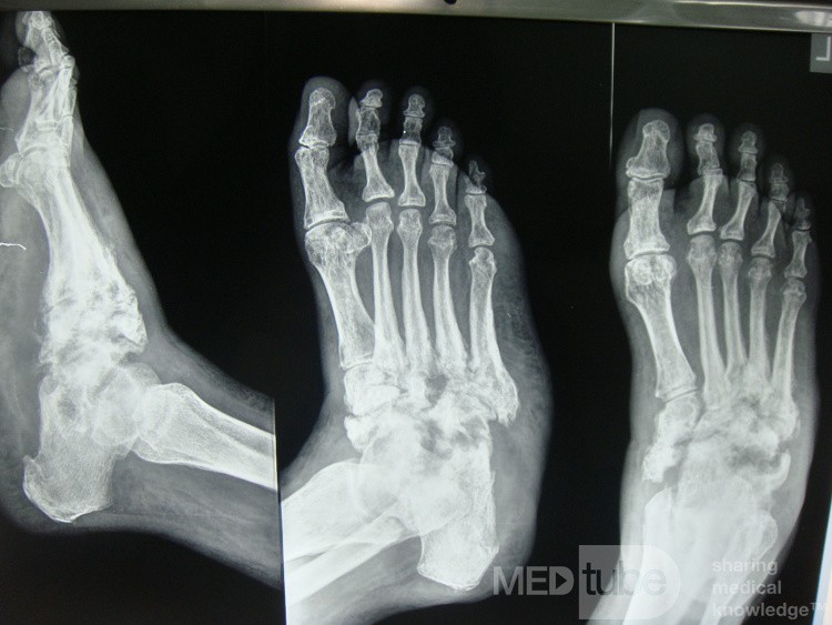 El pie de Charcot