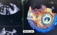 Fuga de la válvula mitral y paravalvular
